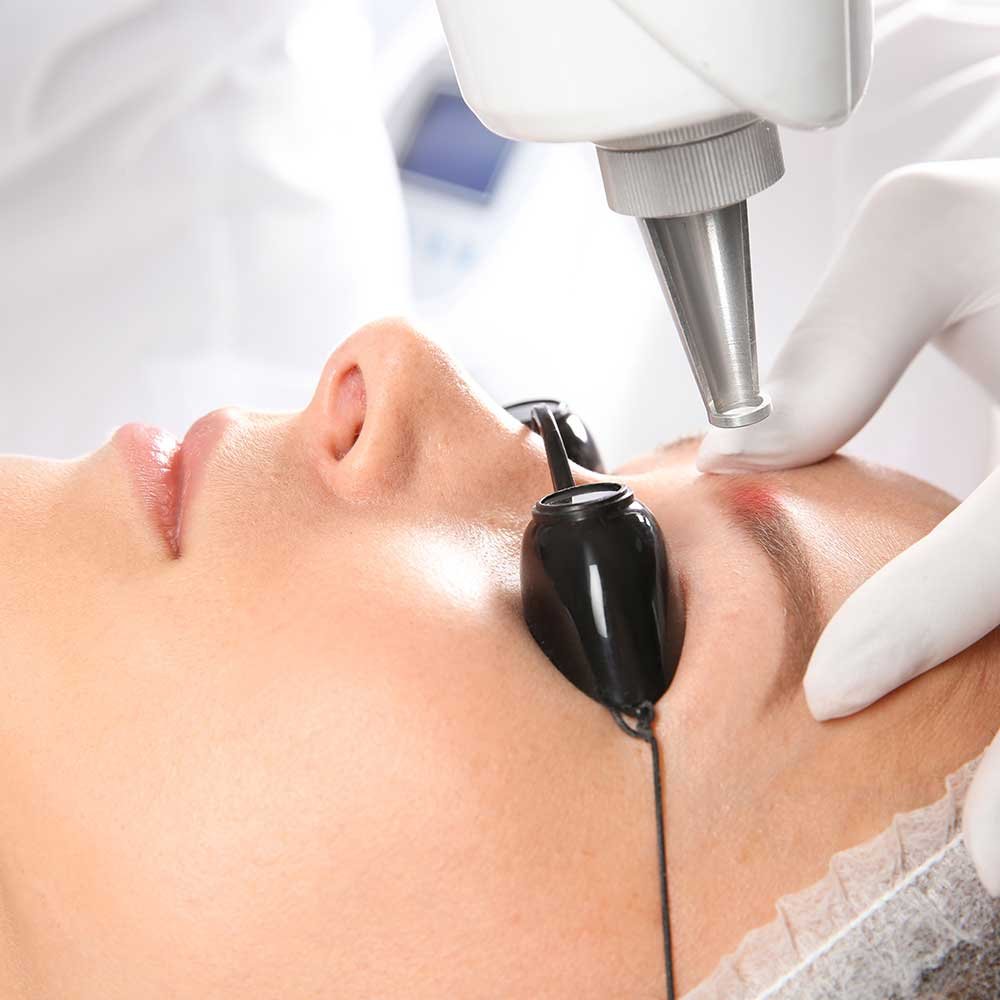 Permanent makeup removal treatment performed at Candibrows