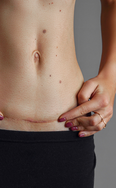 Burn scar camouflage tattoo at Candibrows creating smoother, more even-looking skin