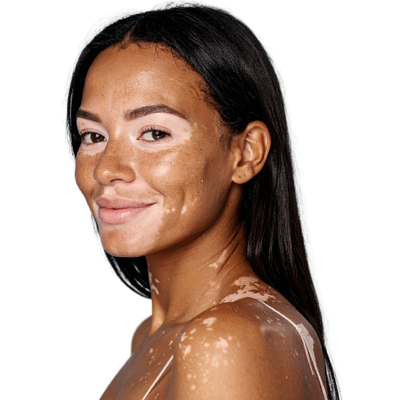 Skin camouflage treatment at Candibrows blending lighter areas for a natural, even tone