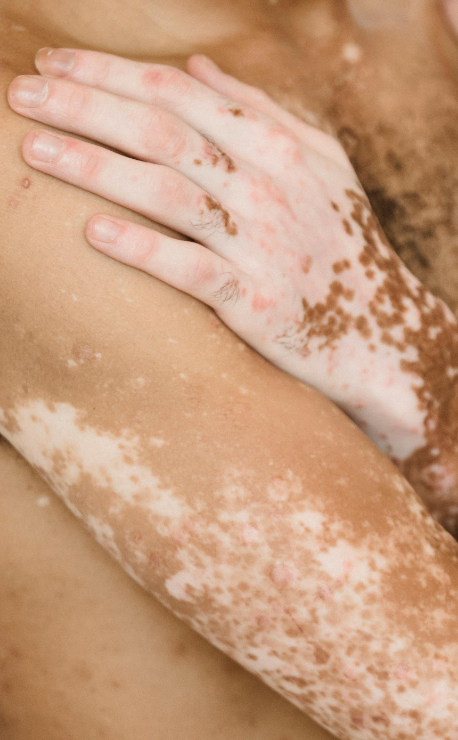 Vitiligo camouflage tattoo at Candibrows creating balanced, natural-looking skin tone