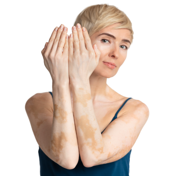 Paramedical skin camouflage at Candibrows reducing contrast between pigmented and light areas